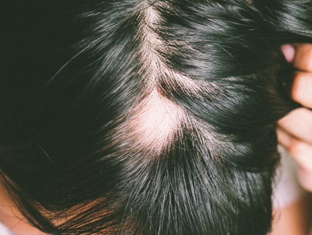 Alopecia - Skin Health Institute