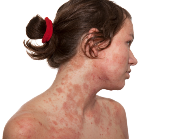 Contact Dermatitis Clinic - Skin Health Institute