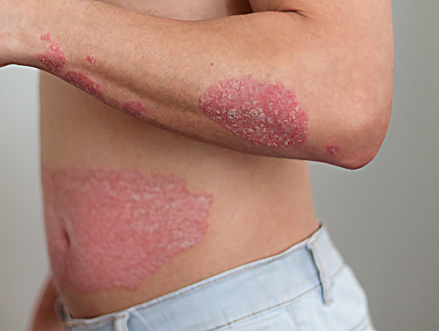 Psoriasis - Skin Health Institute