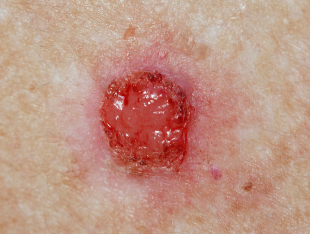 Skin Cancer Skin Health Institute