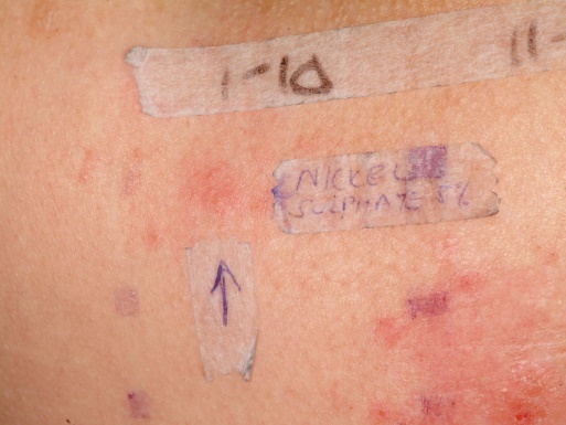 O:\Common\Patients\ACD nickel patch leteral back Paula Hyland.JPG