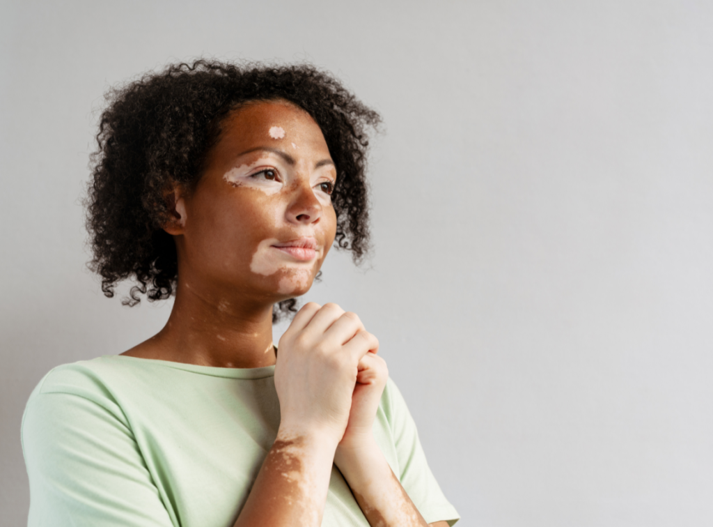 new vitiligo research